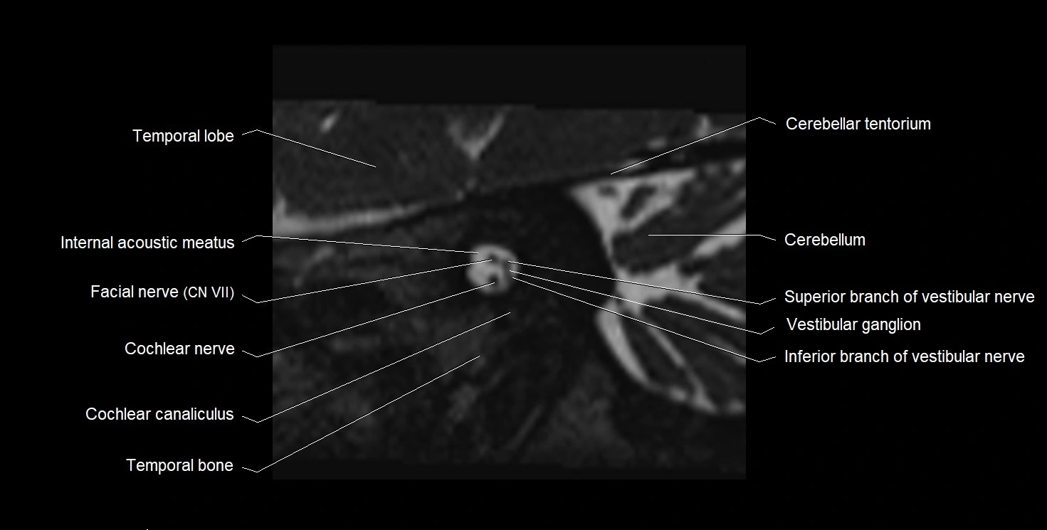 Internal auditory meatus (IAM) 3T sagittal cross sectional anatomy image 17.webp